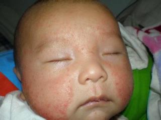 婴儿湿疹